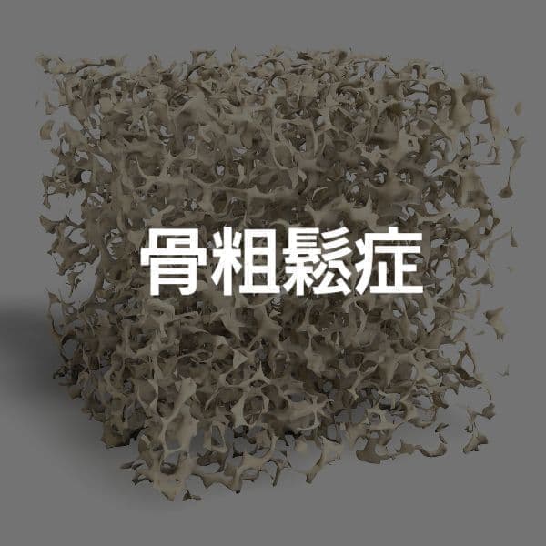 大阪　骨粗鬆症治療